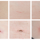 Wound healing from day 25 to 40. Top row are wounds closed with microMend, bottom row with conventional sutures. (Image: KitoTech Medical)